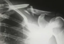 Docente fue agredido por estudiante y su acudiente en La Estrella: le fracturaron una pierna